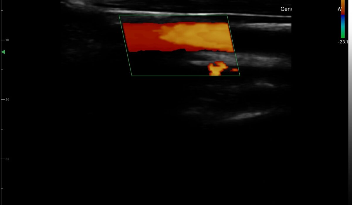 carotid_artery_in_color_mode
