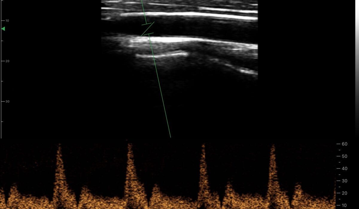 carotid_artery_in_pw_mode