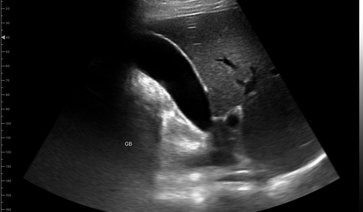 gall_bladder_in_2d_mode